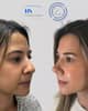 Slider image (10) Dr. Guillermo Guerra Gil de Leyva - Rhinoplasty Specialist